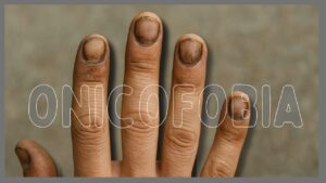 Onicofobia: El miedo a las uñas que pocos conocen.